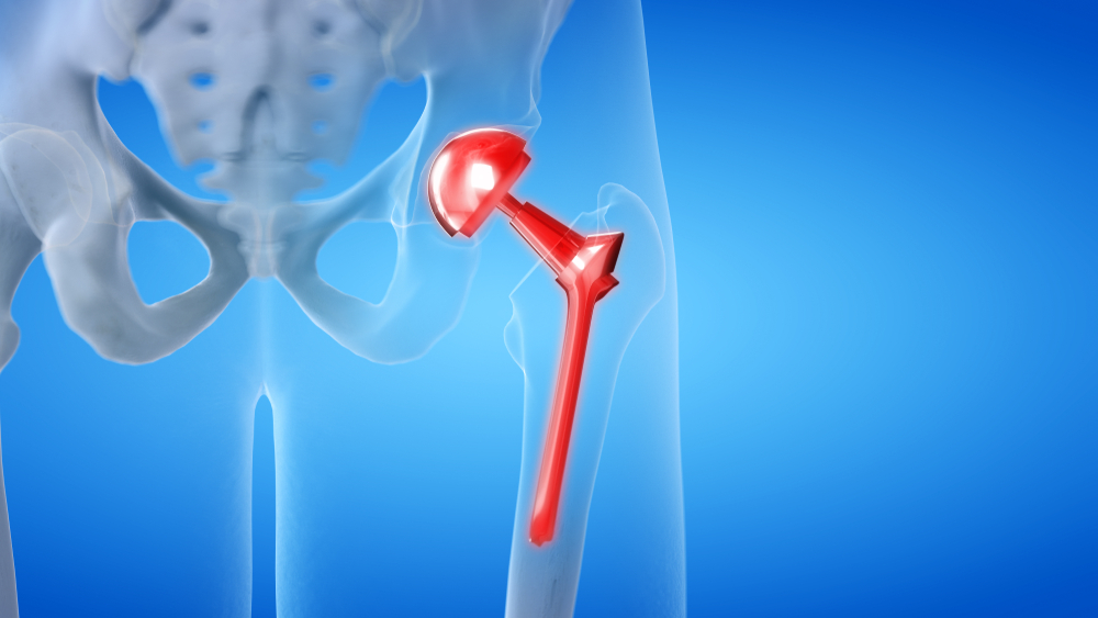 minimally invasive anterior hip replacement