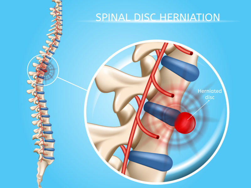 spine surgery herniated disc