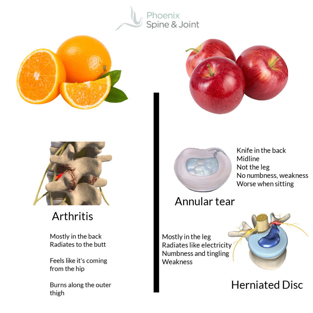 Should You Take Collagen or Glucosamine/Chondroitin for a Herniated